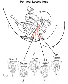 perineal lac.